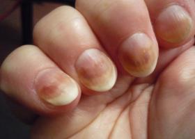 Restabilirea sănătății unghiilor după shellac